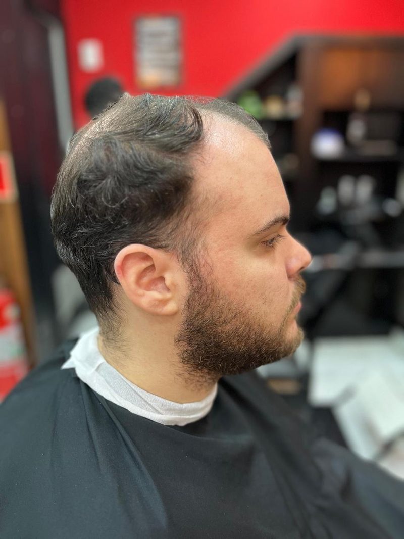 Cliente antes da prótese capilar, vista lateral